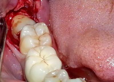 درمان درد دندان عقل چگونه است؟